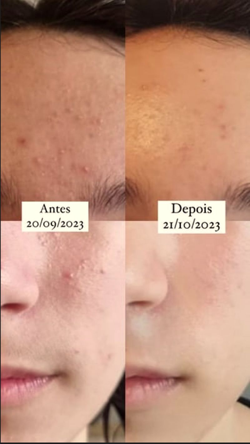 Acne sob controle
